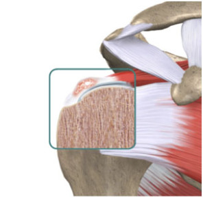 tendinite calcaria