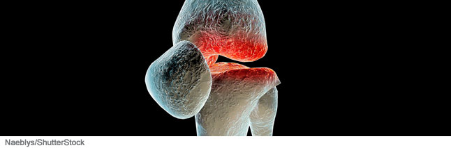 Mantenha-se saudável e evite a osteoartrite